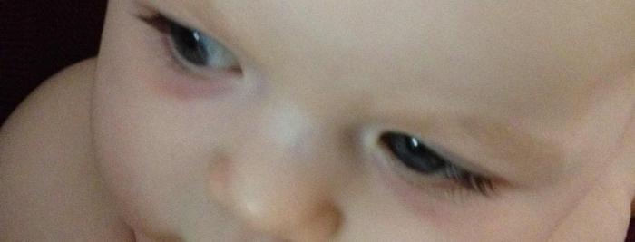 Dítě má modřiny pod očima